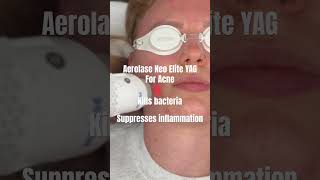 The Aerolase Neo elite yag laser for Acne esthetician acnetreatment aerolase [upl. by Idnyl]