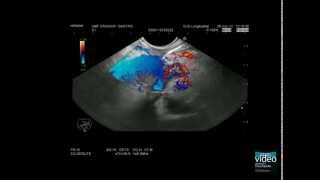 Advanced EUS imaging CEEUS lowMI high MI including 3D techniques in pancreatic imaging [upl. by Hgielsa]