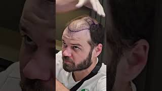 Hair Transplant 5 month Result  Hair Transplant Timelapse  Hair Transplant in Turkey [upl. by Nemzzaj]