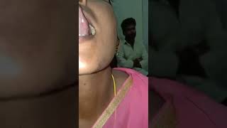 Haemangioma tongue cured with 99 alcohol  DrJagan Mohan Reddy [upl. by Kerril807]