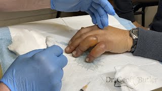 Drainage of blisters secondary to frostbite [upl. by Cowie]