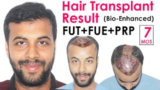 Best Hair Transplant Results  7 Months Hair Transplant Result in India  Medispa Jaipur Rajasthan [upl. by Eimaraj455]