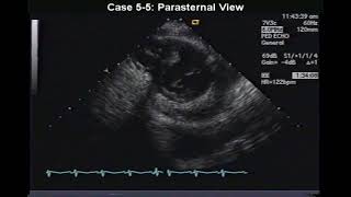 P123 Case 55 Fibrinous Pericarditis [upl. by Burner540]