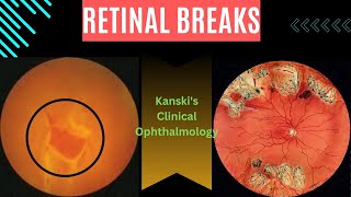 Retinal breaksKanskis clinical ophthalmology retinal tear retinal detachment subretinal fluid [upl. by Custer]