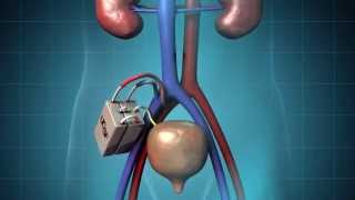 The Kidney Project at UCSF [upl. by Mcnalley]