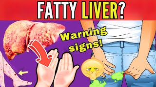 8 SIGNS THAT INDICATE LIVER FAT  EARLY SYMPTOMS OF HEPATIC STEATOSIS silent threat [upl. by Selfridge]