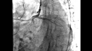 Angiografía coronaria  arterias cardiacas normales [upl. by Adaliah]