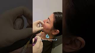 Cannula Filler Technique by Dr Wilfred Tam MD in Toronto filler cannula [upl. by Ekusoyr]