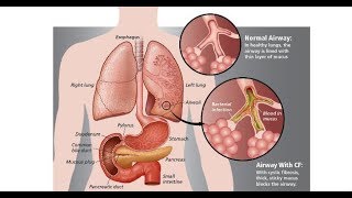 ¿Que es la Enfermedad Fibroquistica del Páncreas FQP Fibroisis quistica o Mucoviscidosis [upl. by Araht]