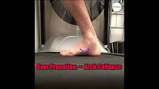 Understanding Over Pronation How it Leads to Collapsed Arches and Heel Pain [upl. by Amor528]