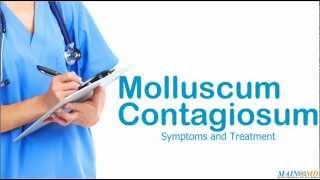 Molluscum Contagiosum ¦ Treatment and Symptoms [upl. by Neenaj]