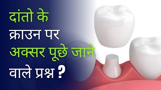 दांतो के क्राउन पर अक्सर पूछे जाने वाले प्रश्न   Faqs on Crowns [upl. by Yelsehc]