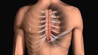 How Does Heart Bypass Surgery Work Coronary Artery Bypass Graft Procedure Animation  CABG Video [upl. by Weinberg]