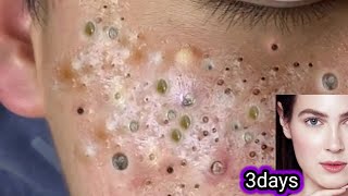 blackhead and whiteheads removal👌facial how to reduce acnepimpleblackheadsget fairclear skin [upl. by Aharon]