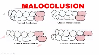 Malocclusion  Part I [upl. by Orgell201]