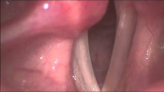 Right vocal cord fold paralysis [upl. by Purdy123]