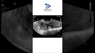 Unruptured right ectopic tubal gestationdamayanthichandana [upl. by Heim]