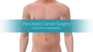 Distal Pancreatectomy How the Procedure Is Performed [upl. by Lenoyl]