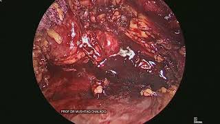 lap retroperitoneal ureterolithotomy for 35 cm upper ureteric stone [upl. by Georgeanne315]