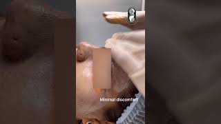 COSMELANstrongest depigmentation peel [upl. by Manolo499]