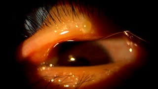 Eye Stye Hordeolum  Causes Symptoms Diagnosis amp At Home Treatments [upl. by Nochur80]