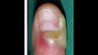 Paronychia Acute and Chronic  Easily Explained  less than 6 mins [upl. by Notsag76]