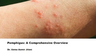 Understanding Pemphigus Causes Symptoms and Treatment of This Rare Autoimmune Skin Disorder [upl. by Ratna48]