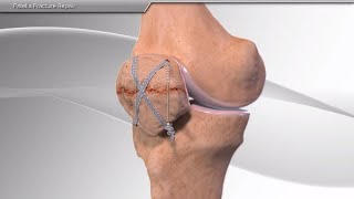 Patella Fracture Repair [upl. by Maharg475]