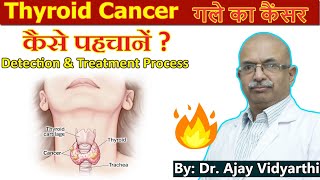 Thyroid Cancer Symptoms amp Treatment  गले का कैंसर  Process of Treatment  By Dr Ajay Vidyarthi [upl. by Tizes]