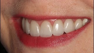 Como Faço uma Prótese Dentária de Silicone Removível Como Faço para Ter uma Prótese Dessa [upl. by Ardnassak]