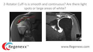 How to read your shoulder MRI with Dr Centeno of Regenexx [upl. by Arrakat]