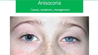 Pupil abnormality series lecture 5 Anisocoria  causes  diagnosis  management [upl. by Aretina254]