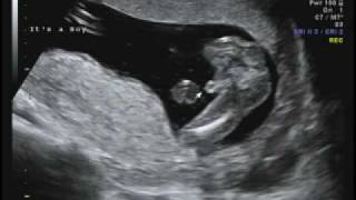 16 weeks Ultrasound  Its a Boy [upl. by Jeritah2]