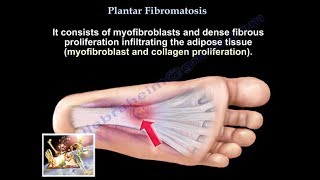 Plantar Fibromatosis  Everything You Need To Know  Dr Nabil Ebraheim [upl. by Nnaxor491]