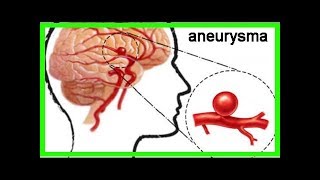 Aneurysma im Gehirn – Was ist das [upl. by Arinaj255]