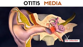 Otitis Media  Ear Infection [upl. by Nitsur669]