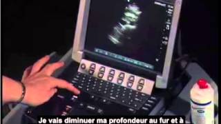 Comment  Réaliser une échographie de laorte abdominale [upl. by Dranik734]