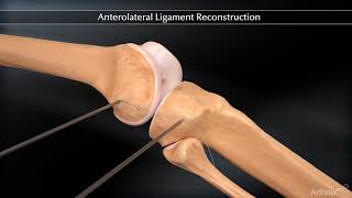 Réparation du Ligament Antéro Latéral [upl. by Acnairb]