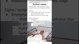 Human rabies [upl. by Worsham]