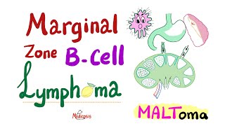 Marginal Zone BCell lymphoma MALToma  Indolent BCell NonHodgkin’s Lymphoma  Hematology Onco [upl. by Randie343]