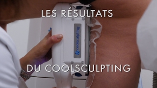 Les résultats du COOLSCULPTING sur lintérieur des cuisses  Centre Marceau Paris [upl. by Ahsenot812]