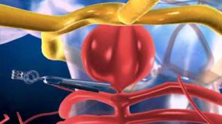 Aneurysm in the Brain and Clipping  3D medical animation  ABP © [upl. by Annawot286]