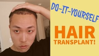 DoItYourself DIY Hair Transplant Possible [upl. by Bollen624]