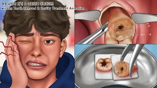 ASMR 매복 사랑니 제거 amp 충치치료 풀버전  치아미백  Wisdom Tooth amp Cavity Treatment Animation [upl. by Aiuqram]