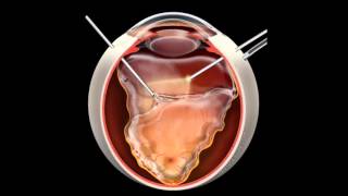 Retinal Detachment  Signs Symptoms and Treatment [upl. by Yhtomot926]