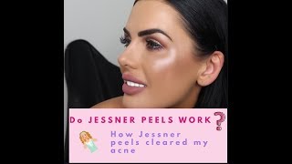 Jessner Peels and how they helped my skin [upl. by Graeme349]