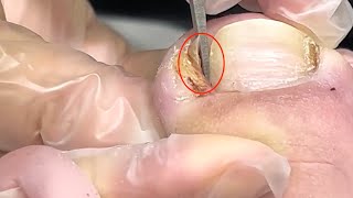 【Daily Pedicure Tutorial】Trimming This Flat and Deeply Embedded Ingrown Toenail [upl. by Musette653]