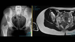 Aneurysmal bone cyst ilium [upl. by Anwahsed414]