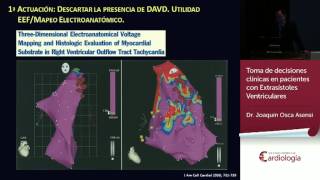 Toma de decisiones clínicas en pacientes con Extrasístoles Ventriculares [upl. by Nosac]