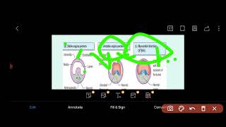 Internal Medicine  Cardiology Ischemic Heart Disease [upl. by Leinadnhoj305]